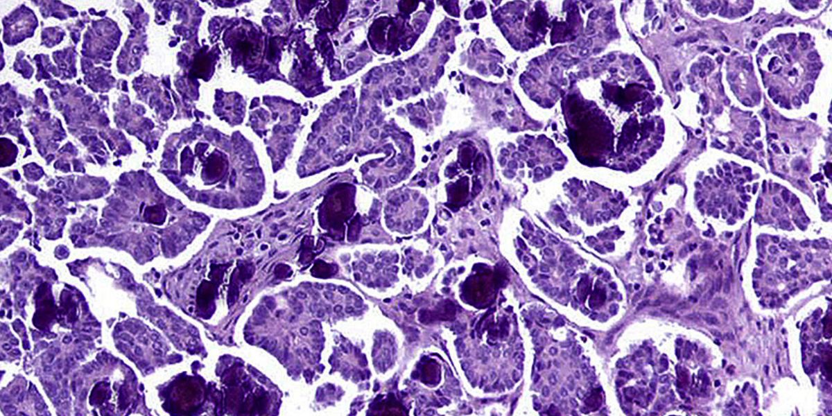 Dark and light purple marbeled with white showing how LGSOC cells look under a microscope